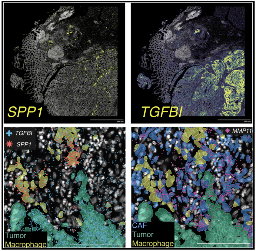 Landscape of immune cell infiltration in colorectal cancer